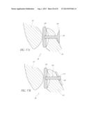 VERTEBRAL FACET JOINT PROSTHESIS AND METHOD OF FIXATION diagram and image