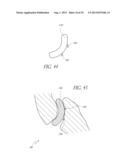 VERTEBRAL FACET JOINT PROSTHESIS AND METHOD OF FIXATION diagram and image