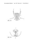 VERTEBRAL FACET JOINT PROSTHESIS AND METHOD OF FIXATION diagram and image