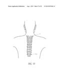 VERTEBRAL FACET JOINT PROSTHESIS AND METHOD OF FIXATION diagram and image