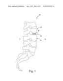 EXPANDABLE SPINAL INTERBODY AND INTRAVERTEBRAL BODY DEVICES diagram and image