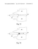 EXPANDABLE SPINAL INTERBODY AND INTRAVERTEBRAL BODY DEVICES diagram and image