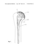 ROTATABLE COLLAR FOR A PROSTHESIS diagram and image