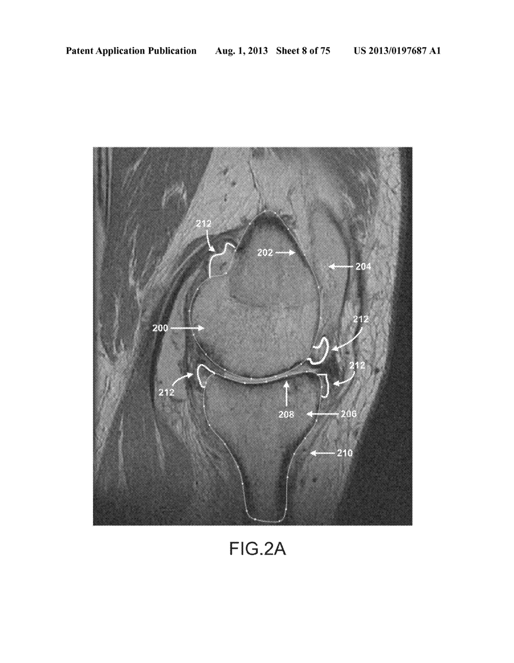 SYSTEM AND METHOD FOR IMAGE SEGMENTATION IN GENERATING COMPUTER MODELS OF     A JOINT TO UNDERGO ARTHROPLASTY - diagram, schematic, and image 09