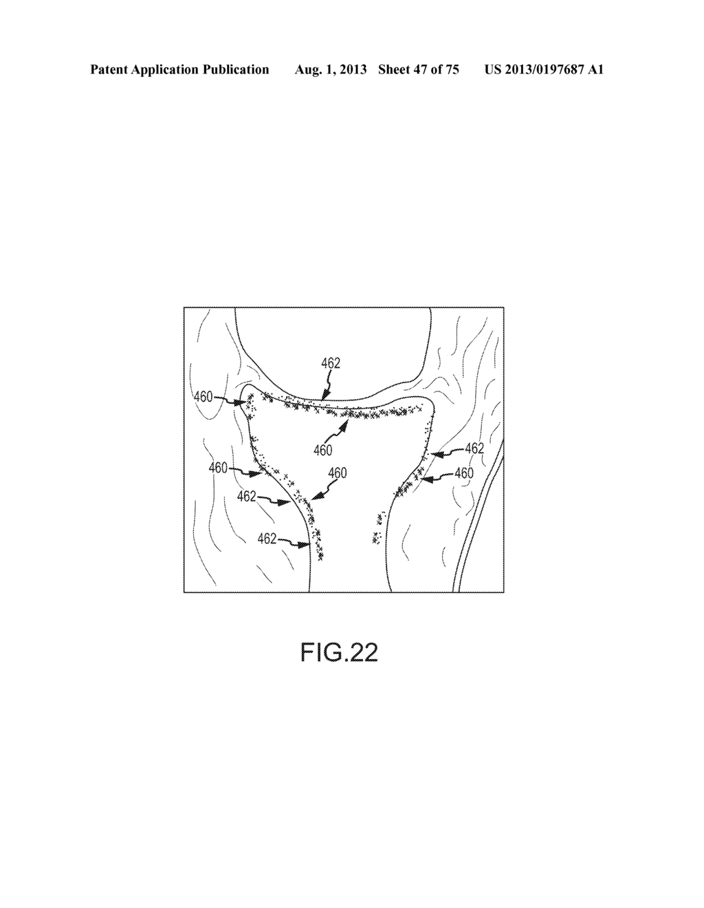 SYSTEM AND METHOD FOR IMAGE SEGMENTATION IN GENERATING COMPUTER MODELS OF     A JOINT TO UNDERGO ARTHROPLASTY - diagram, schematic, and image 48