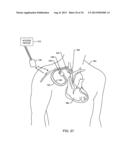 RFID INTERROGATOR CONFIGURED FOR PROTECTION AGAINST ELECTROMAGNETIC     INTERFERENCE OF A REMOTE DEVICE HAVING AN RFID TAG diagram and image