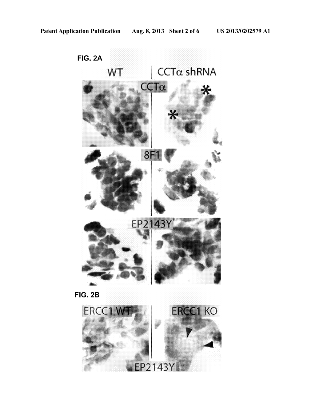 USE OF CHOLINE-PHOSPHATE CYTIDYLYLTRANSFERASE-ALPHA (CCT-ALPHA) AS A     BIOMARKER FOR CANCER PROGNOSIS - diagram, schematic, and image 03