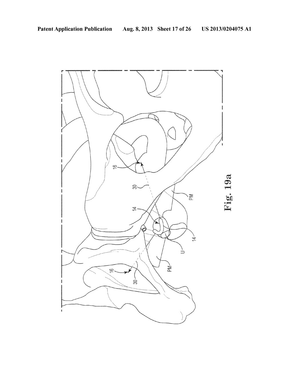 Pelvic Implant System and Method - diagram, schematic, and image 18