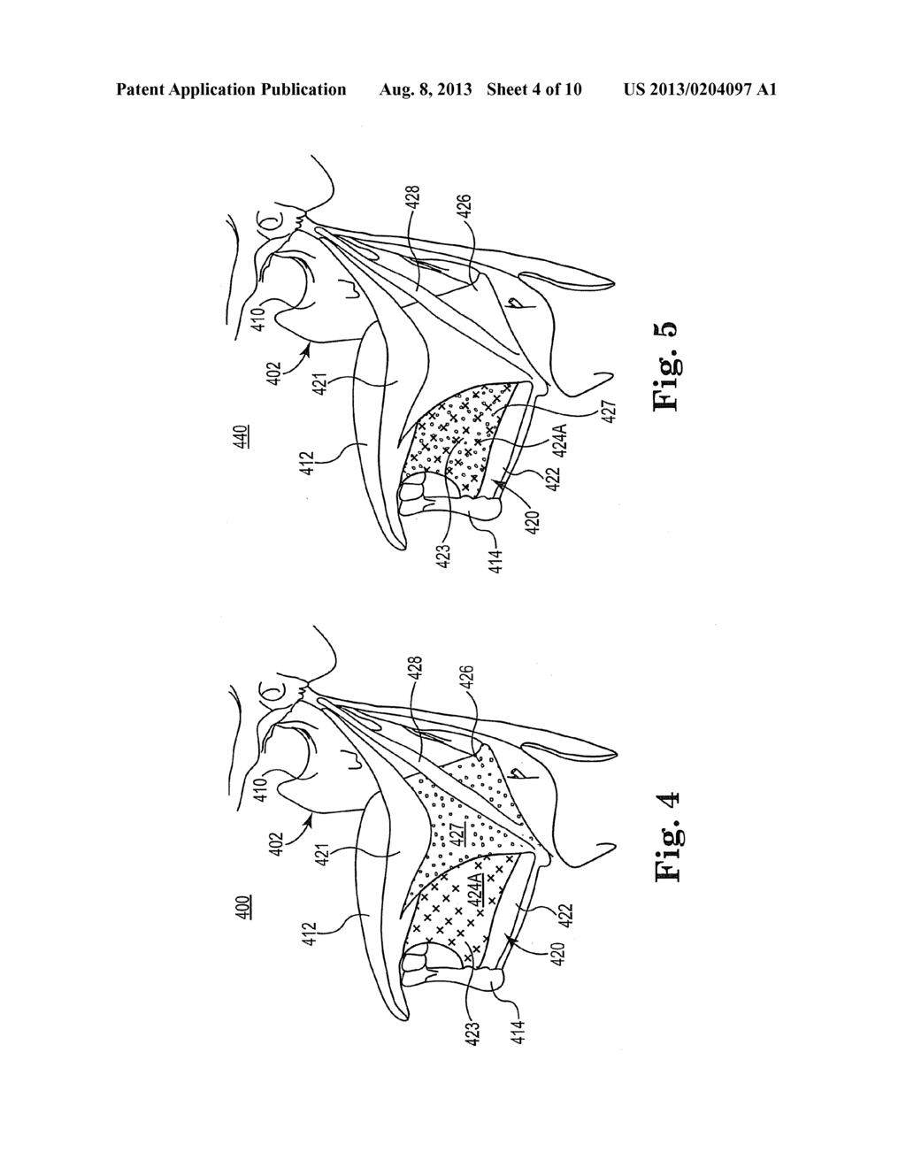 METHOD AND SYSTEM FOR IDENTIFYING A LOCATION FOR NERVE STIMULATION - diagram, schematic, and image 05