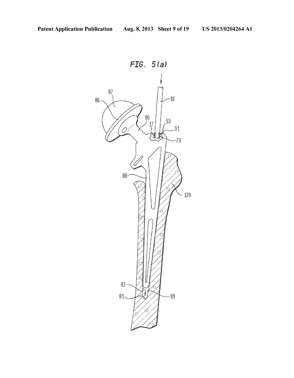 Pneumatic Surgical Instrument and Corresponding Methods for Implanting     Orthopedic Implants in Bone - diagram, schematic, and image 10