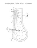 Method And Apparatus For Aligning Bone Screw Holes diagram and image