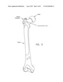 METHOD AND APPARATUS FOR ATTACHING TISSUE TO BONE, INCLUDING THE PROVISION     AND USE OF A NOVEL KNOTLESS SUTURE ANCHOR SYSTEM diagram and image