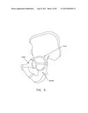 METHOD AND APPARATUS FOR ATTACHING TISSUE TO BONE, INCLUDING THE PROVISION     AND USE OF A NOVEL KNOTLESS SUTURE ANCHOR SYSTEM diagram and image