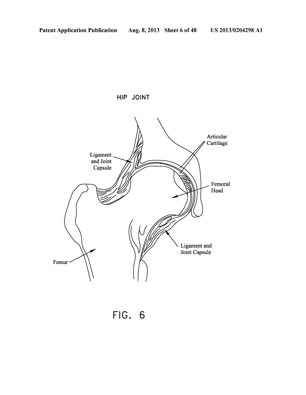 METHOD AND APPARATUS FOR ATTACHING TISSUE TO BONE, INCLUDING THE PROVISION     AND USE OF A NOVEL KNOTLESS SUTURE ANCHOR SYSTEM - diagram, schematic, and image 07