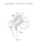 METHOD AND APPARATUS FOR ATTACHING TISSUE TO BONE, INCLUDING THE PROVISION     AND USE OF A NOVEL KNOTLESS SUTURE ANCHOR SYSTEM diagram and image