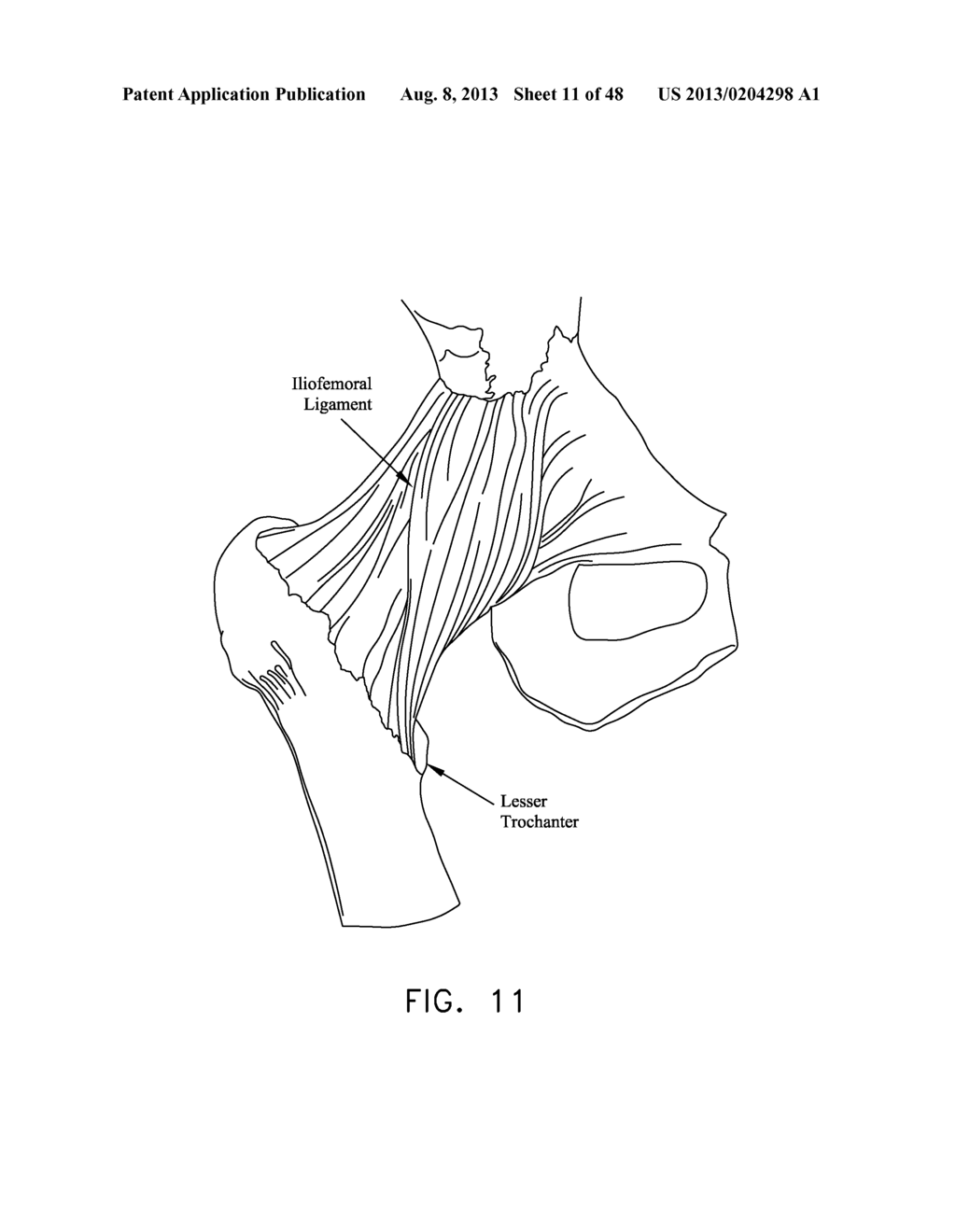 METHOD AND APPARATUS FOR ATTACHING TISSUE TO BONE, INCLUDING THE PROVISION     AND USE OF A NOVEL KNOTLESS SUTURE ANCHOR SYSTEM - diagram, schematic, and image 12