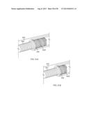 IMPLANTS AND METHODS FOR TREATING CARDIAC ARRHYTHMIAS diagram and image