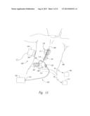 SELECTIVE HIGH FREQUENCY SPINAL CORD MODULATION FOR INHIBITING PAIN WITH     REDUCED SIDE EFFECTS, AND ASSOCIATED SYSTEMS AND METHODS diagram and image