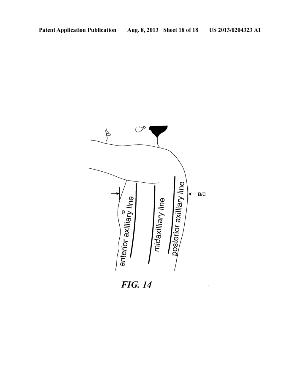 SELECTIVE HIGH FREQUENCY SPINAL CORD MODULATION FOR INHIBITING PAIN,     INCLUDING CEPHALIC AND/OR TOTAL BODY PAIN WITH REDUCED SIDE EFFECTS, AND     ASSOCIATED SYSTEMS AND METHODS - diagram, schematic, and image 19