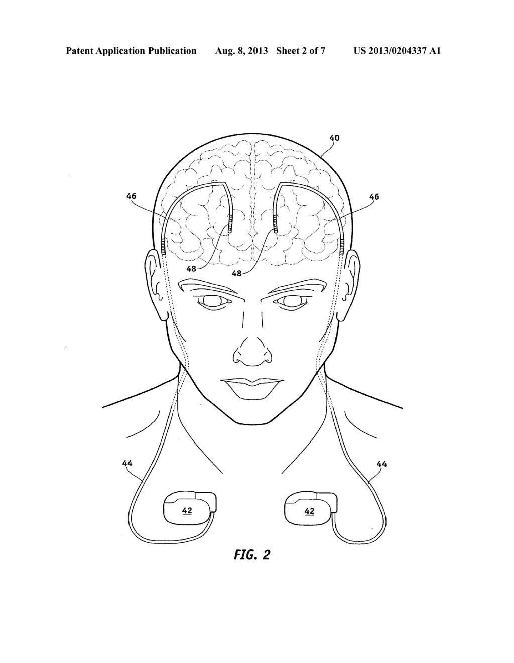 MRI-Safe Implantable Medical Device - diagram, schematic, and image 03