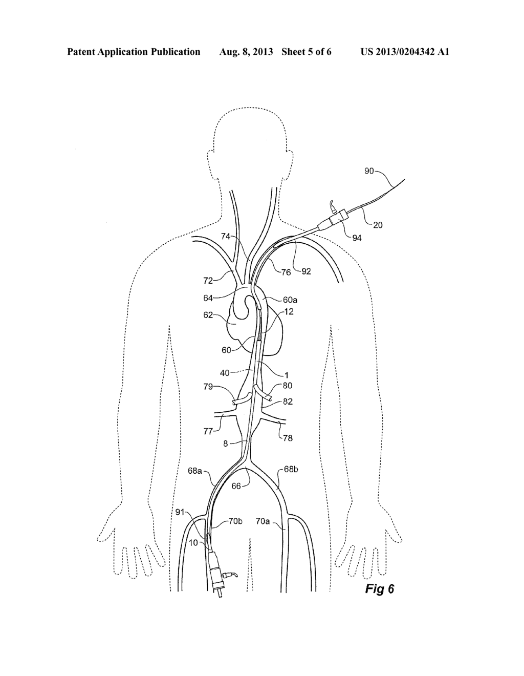 ORIENTATION MARKERS FOR ENDOVASCULAR DELIVERY SYSTEM - diagram, schematic, and image 06