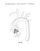 Transcatheter Valve Delivery Systems and Methods diagram and image