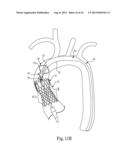 Transcatheter Valve Delivery Systems and Methods diagram and image