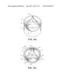 Prosthetic Tissue Valve diagram and image