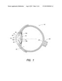 Accommodative Intraocular Lens Having a Haptic Plate diagram and image