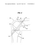 FLIPPING-TYPE GRAFT FIXATION DEVICE AND METHOD diagram and image