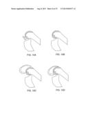 SYSTEMS AND METHODS FOR PROVIDING A MODULAR FEMORAL COMPONENT diagram and image