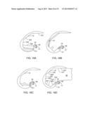 SYSTEMS AND METHODS FOR PROVIDING A MODULAR FEMORAL COMPONENT diagram and image