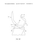 SYSTEMS AND METHODS FOR PROVIDING A MODULAR FEMORAL COMPONENT diagram and image