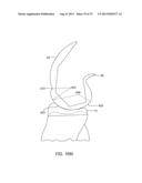 SYSTEMS AND METHODS FOR PROVIDING A MODULAR FEMORAL COMPONENT diagram and image