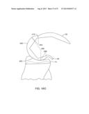 SYSTEMS AND METHODS FOR PROVIDING A MODULAR FEMORAL COMPONENT diagram and image