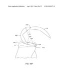 SYSTEMS AND METHODS FOR PROVIDING A MODULAR FEMORAL COMPONENT diagram and image