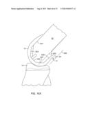 SYSTEMS AND METHODS FOR PROVIDING A MODULAR FEMORAL COMPONENT diagram and image