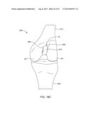 SYSTEMS AND METHODS FOR PROVIDING A MODULAR FEMORAL COMPONENT diagram and image