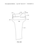 SYSTEMS AND METHODS FOR PROVIDING A MODULAR FEMORAL COMPONENT diagram and image