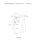 SYSTEMS AND METHODS FOR PROVIDING A MODULAR FEMORAL COMPONENT diagram and image