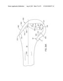 SYSTEMS AND METHODS FOR PROVIDING A MODULAR FEMORAL COMPONENT diagram and image