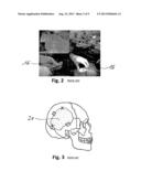 METHOD AND DEVICE FOR FABRICATING A PATIENT-SPECIFIC IMPLANT diagram and image