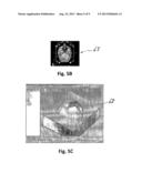 METHOD AND DEVICE FOR FABRICATING A PATIENT-SPECIFIC IMPLANT diagram and image