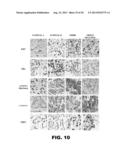 METHOD OF IDENTIFYING TRIPLE NEGATIVE BREAST CANCER diagram and image