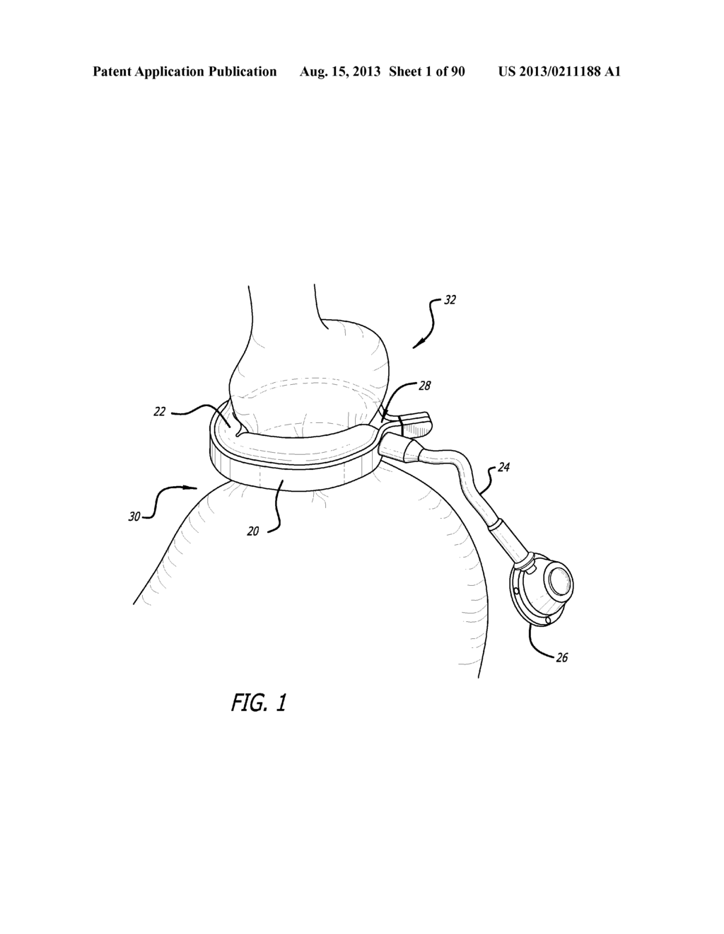 METHOD FOR INCREASING DISTENSIBILITY IN A GASTRIC BAND - diagram, schematic, and image 02