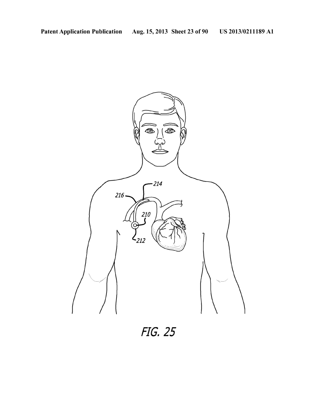 METHOD FOR PROVIDING HIGH BASAL INTRA-LUMINAL PRESSURE USING A GASTRIC     BAND - diagram, schematic, and image 24