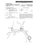 METHOD FOR INCREASING DISTENSIBILITY IN A GASTRIC BAND diagram and image