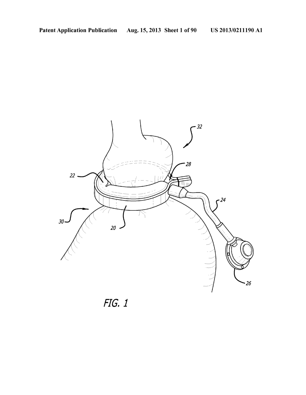 METHOD FOR INCREASING DISTENSIBILITY IN A GASTRIC BAND - diagram, schematic, and image 02