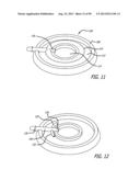 METHOD FOR INCREASING DISTENSIBILITY IN A GASTRIC BAND diagram and image