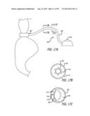 METHOD FOR INCREASING DISTENSIBILITY IN A GASTRIC BAND diagram and image